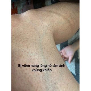 viêm lỗ chân lông kela lotion