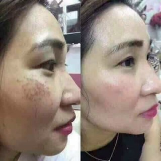 COMBO chăm sóc da NÁM, tàn nhang, thâm mụn…