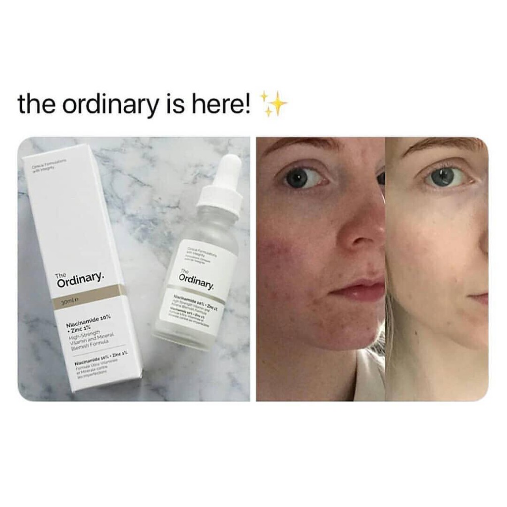 Tinh chất The Ordinary Niacinamide 10% ZinC 1% Serum se khít lỗ chân lông