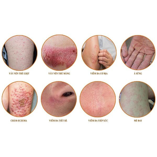 🌿🌿Ngứa,mẩn đỏ, vảy nến, viêm da cơ địa ,mề đay🌿🌿 Kem bôi da Phục Liễu Bì | BigBuy360 - bigbuy360.vn