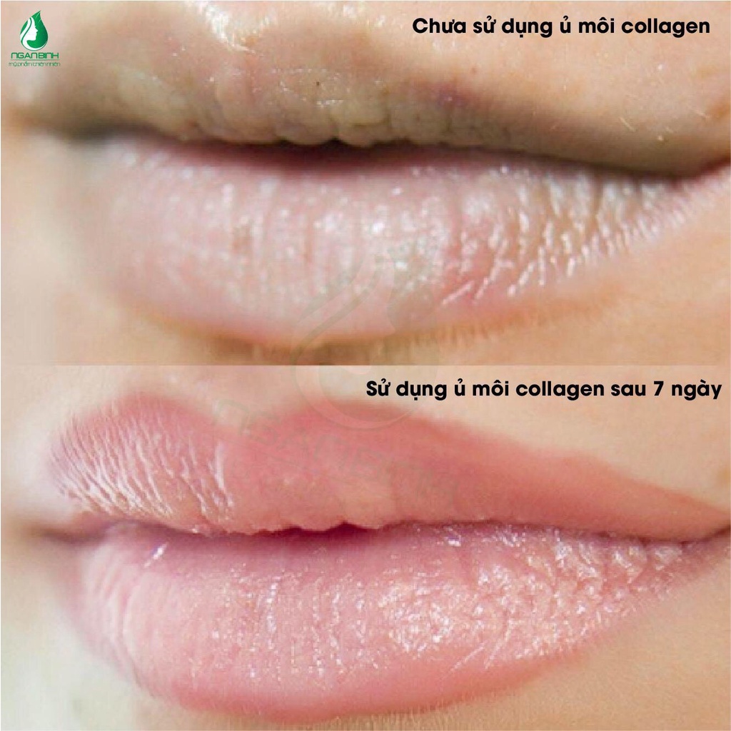 Mặt nạ ủ môi Collagen Ngân Bình loại bỏ tế bào chết cho môi giúp dưỡng môi mềm mại, làm hồng môi, hết thâm