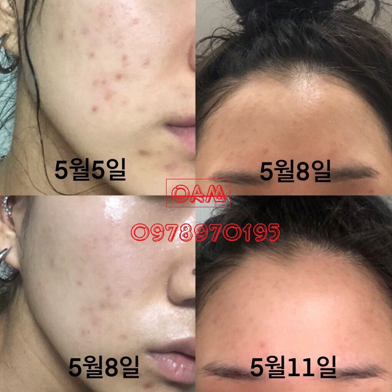 Serum tẩy da chết Lactic Acid + HA 10% +5% 30ml | BigBuy360 - bigbuy360.vn