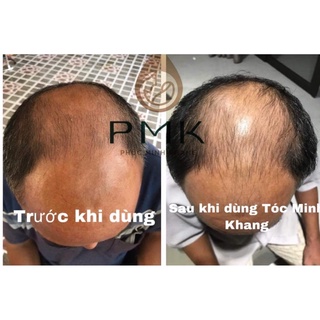 Tinh chất moc Tóc cao cấp Minh Khang