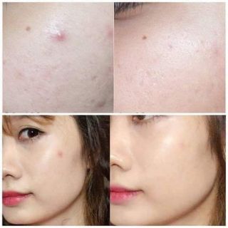 Miếng dán mụn SOME BY MI CLEAR SPOT PATCH