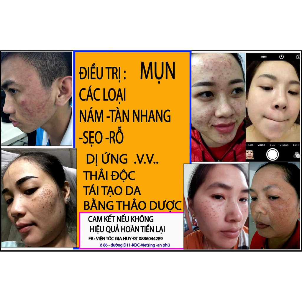 SERUM TÁI TẠO DA PHƯƠNG ANH YODY WHITE