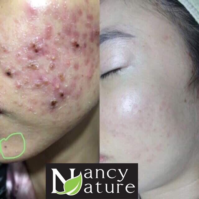 SERUM MỤN NANCYCARE NGỪA MỤN TUYỆT ĐỐI, KHÔNG TÁI PHÁT MỤN SAU KHI NGƯNG SỬ DỤNG, HIỆU QUẢ VƯỢT HƠN SỰ MONG ĐỢI