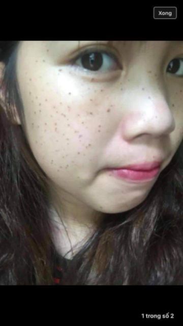 Chấm nám chấm tàn nhang