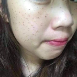Chấm nám chấm tàn nhang