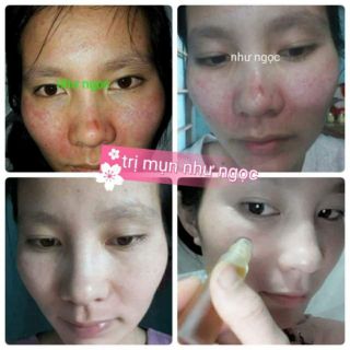 Trị mụn Như Ngọc