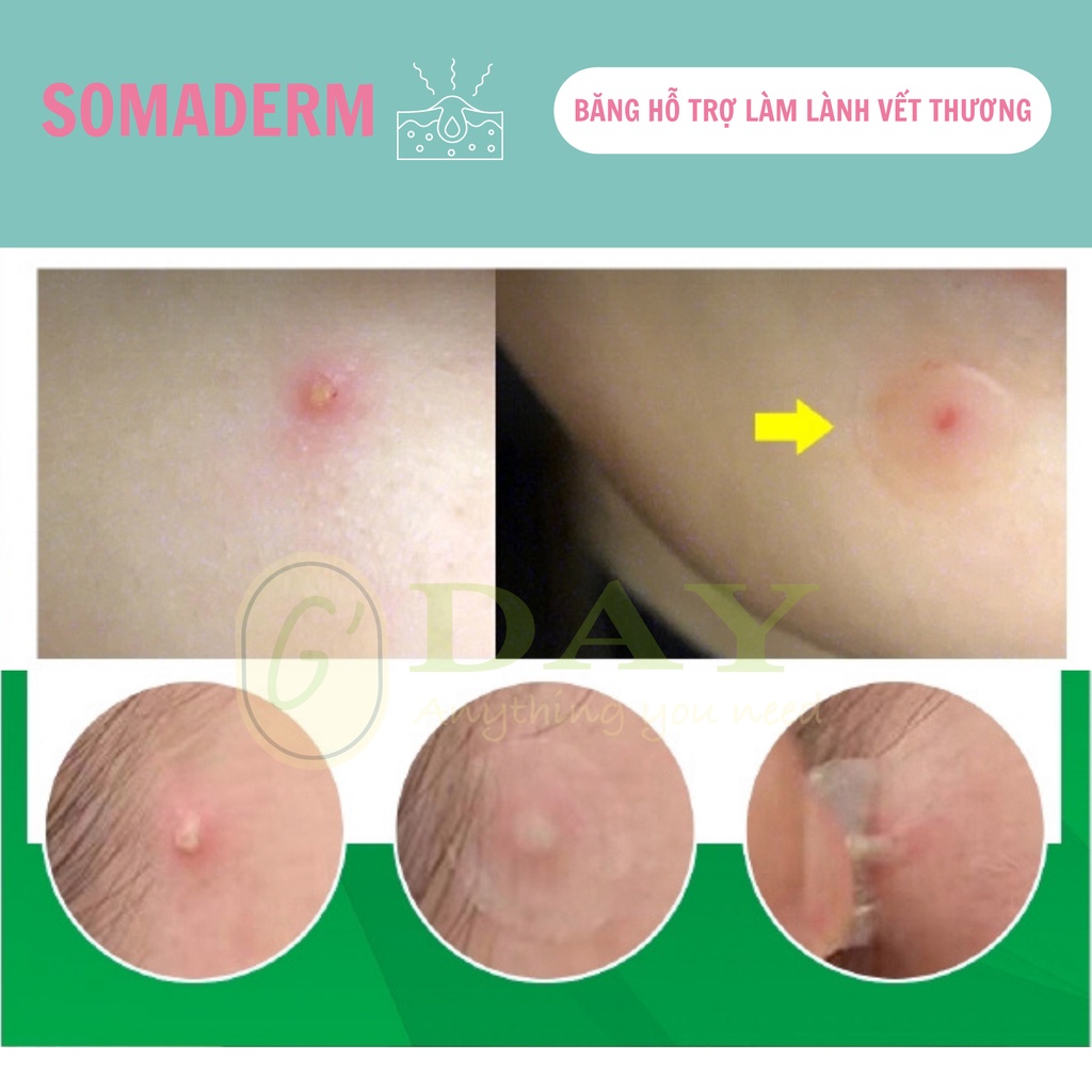 [CHÍNH HÃNG] Combo 5 miếng Dán Mụn Somaderm Spot 18 miếng