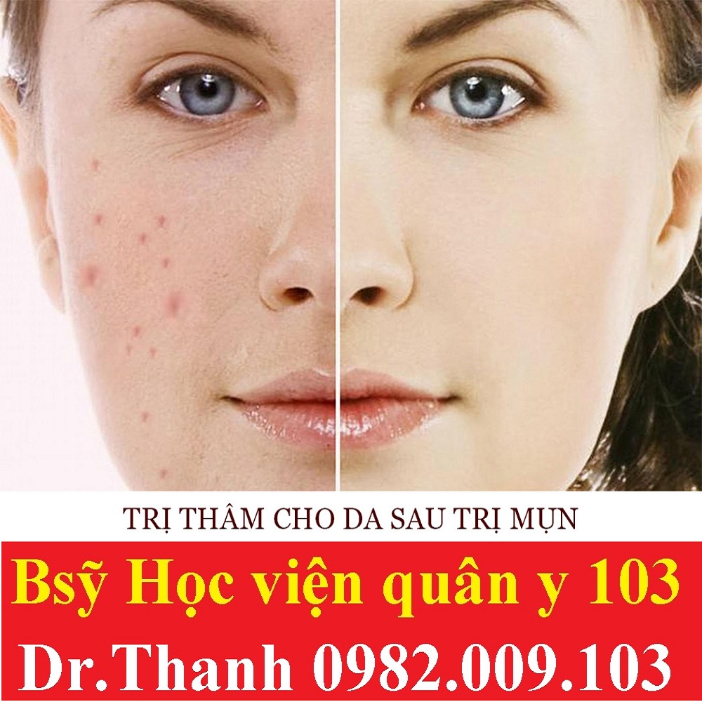 Skincare Tràm Trà - Lá Neem Laco Acnee tinh chất chấm mụn giảm da mụn