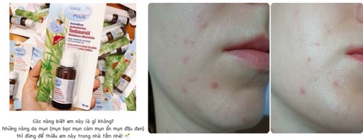 Tinh dầu tràm trà Das Gesunde Plus Teebaumol 30ml