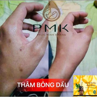 Tinh Chất Mờ Thâm Phúc Minh Khang ( tặng ngay 1 thâm gia truyền 120k)