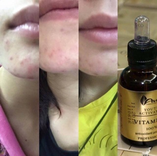 Serum Vitamin C làm trắng da