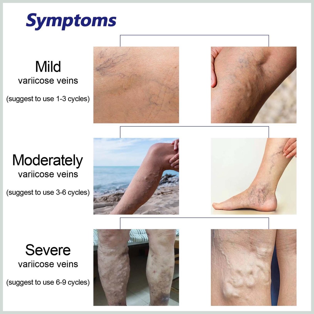 Thuốc Trị Giãn Tĩnh Mạch Chân 1.05oz