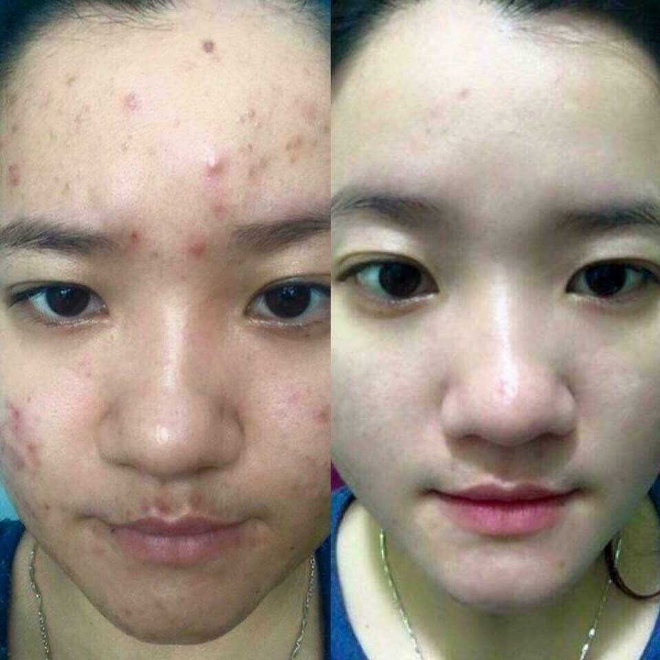 Kem Ngăn Ngừa Mụn Acne Dr Cell