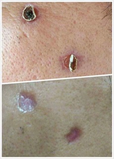 Tẩy mụn ruồi Nga