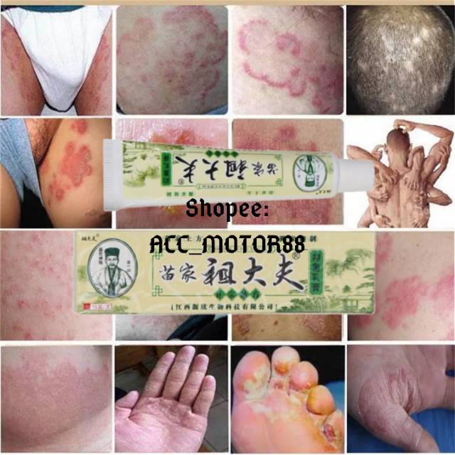 (hàng Mới Về) Thuốc Mỡ Trị Mụn Chiết Xuất Thảo Dược Zudaifu 100% Ori