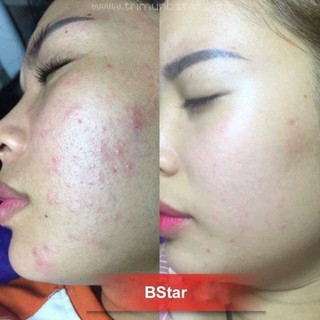 [ Chính Hãng ] Kem Mụn B.Star Cam Kết Chất Lượng Hiệu Quả Với Các Loại Mụn (Mẫu Mới Nhất)