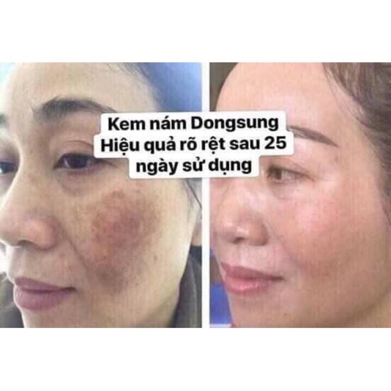 Kem giảm nám Dongsung Rannce Cream mini 10ml