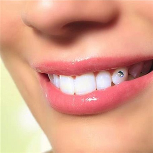 Hạt đính đá trên răng bộ 5 hạt + keo