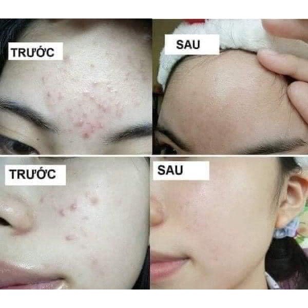 Gel Giảm Mụn thâm MegaDou Gel AHA 15g | BigBuy360 - bigbuy360.vn