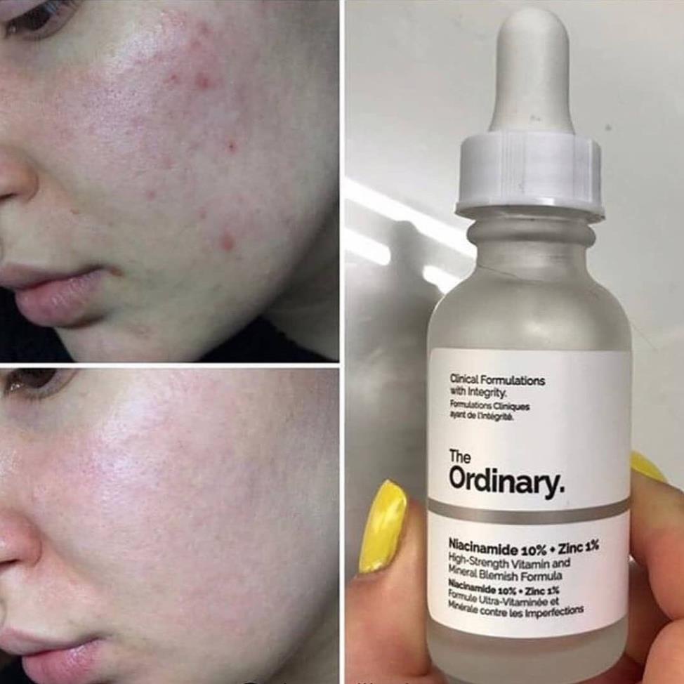 Serum The Ordinary Niacinamide 10% + Zinc 1% giảm mụn mờ thâm 30ml - PINK BEAUTY