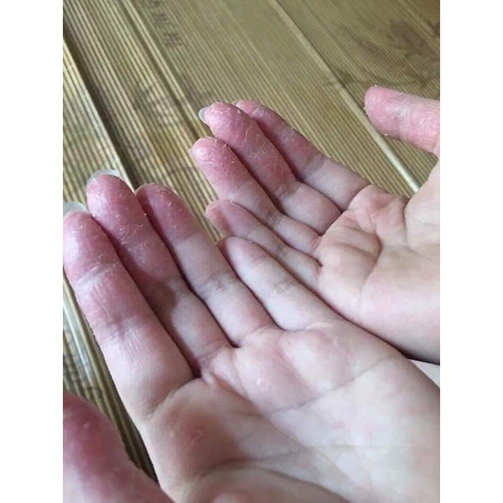 Kem bôi bạch bến nấm ngứa hắc lao