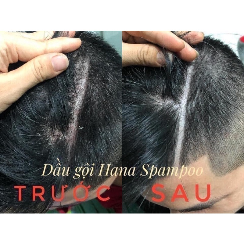 Dầu Gội Hanayuki Shampoo , Dầu gội Hana phục hồi tóc suôn mượt