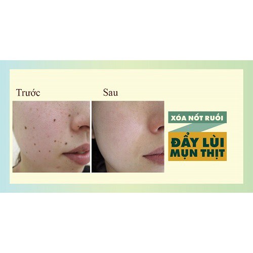 Kem xóa nốt ruồi Nhật TSUBUPORON 20g - Kem tẩy nốt ruồi 4533213678507