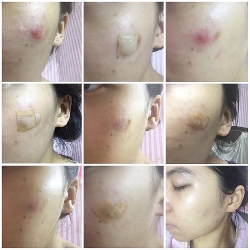 Miếng dán mụn DUODERM