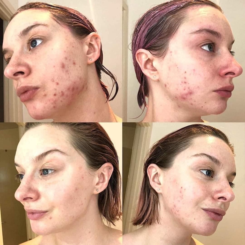 Sữa rửa mặt ZAPZYT Acne Wash Effective & Gentle Cleanser dành cho da mụn & gel bôi mụn benzoyl peroxide 10%