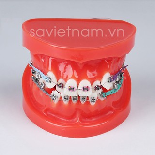 Hàm tư vấn chỉnh nha full khí cụ có nhổ răng trong nha khoa