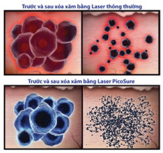 máy laze trục khuỷ PICOWAY