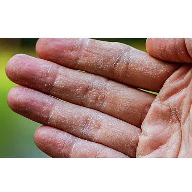 Thảo dược tốt đánh bay bong da đầu ngón tay ngón chân, lòng bàn tay, bàn chân