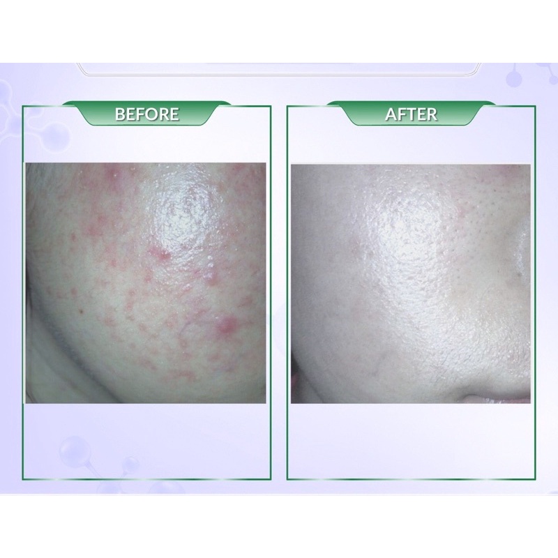 Adapalene Gel 0.1% Adaferin Chính Hãng  trợ thủ dẹp mụn tuyệt đỉnh cho bạn nâng cấp bản thân