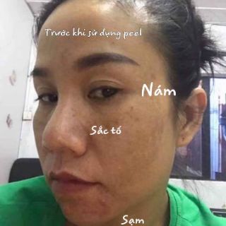 PEEL THAY DA MẶT TCA_USA