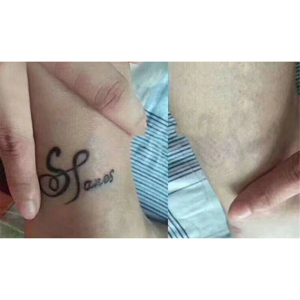 Kem xóa hình xăm an toàn không đau | BigBuy360 - bigbuy360.vn