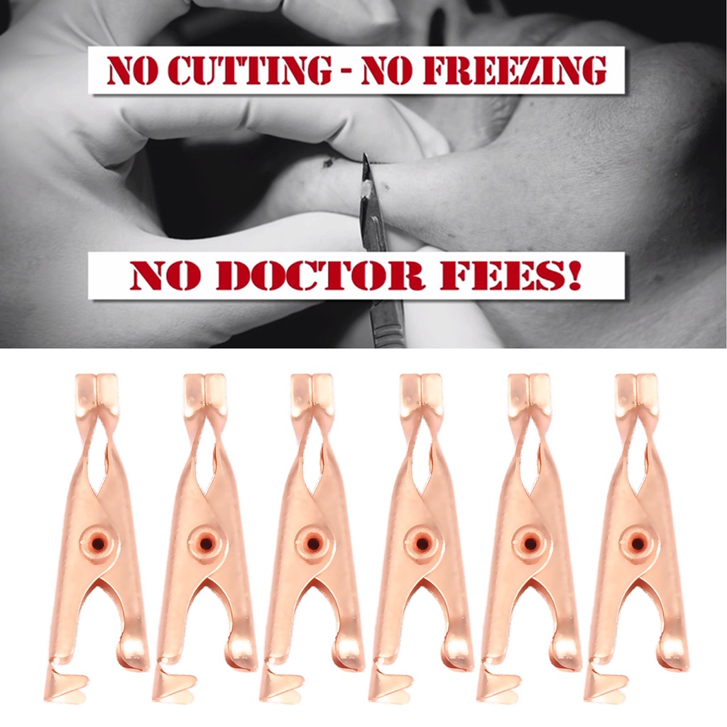 Dụng Cụ Hỗ Trợ Giảm Mụn Đầu Đen / Hình Xăm Dạng Kẹp Tiện Dụng