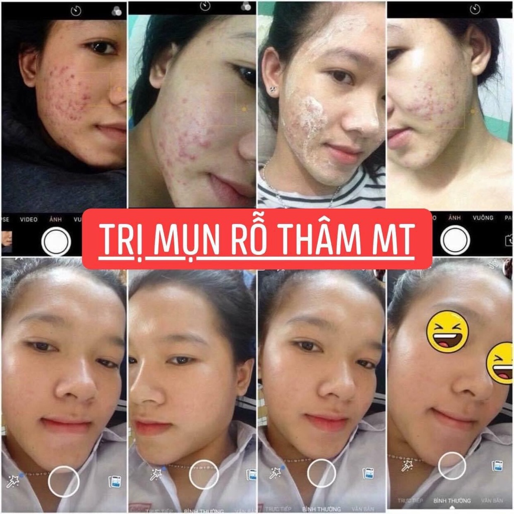 Cốt sâm chuyên mụn thâm nám , tàn nhang ,trắng da , đều màu da  se khít lỗ chân lông