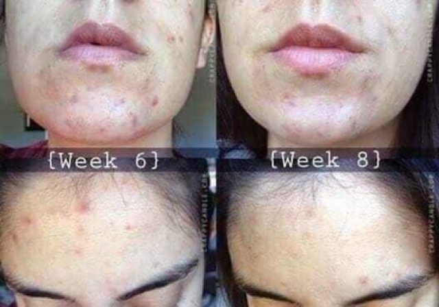 Tinh dầu tràm trà giảm mụn Tea Tree oil The Body Shop | BigBuy360 - bigbuy360.vn