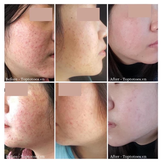 [Mã 12FMCGSALE1 giảm 10% đơn 250K] Serum Teana Super Peptides Anti-redness Aid Kit giảm sưng, mẩn đỏ, mụn, phục hồi da