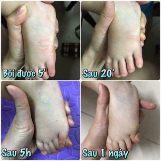 Dầu bôi muỗi cắn