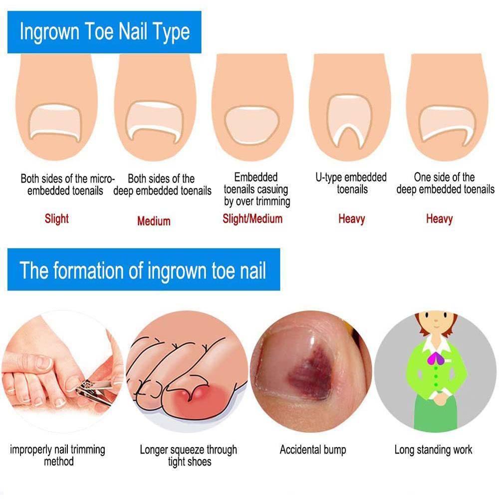 1 Hộp Dụng Cụ Cố Định Móng Chân Bằng Thép Không Gỉ