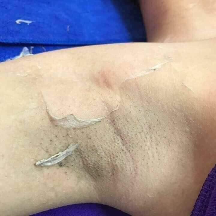 Peel da vi tảo/ thay da sinh học cho mặt, nách, lưng Hanmade