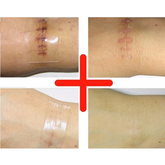 Miếng dán ngăn ngừa và ép sẹo lồi, sẹo phì đại Rejuvaskin Scar FX 2.5x55cm - Aja's Skinlab