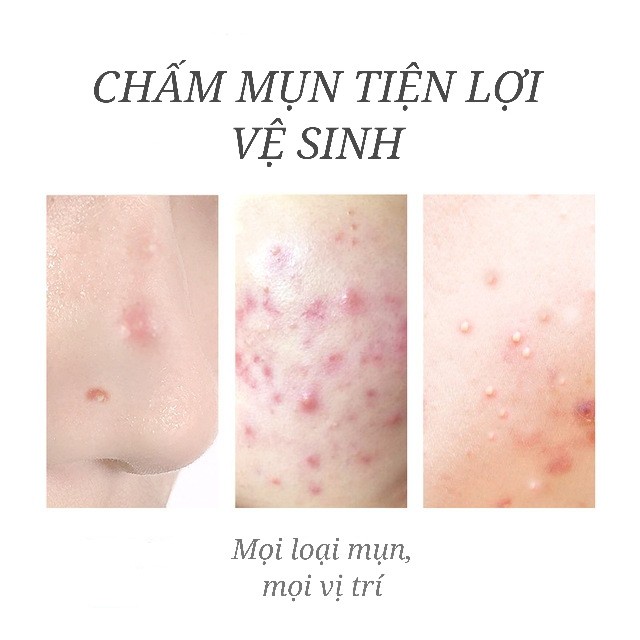 Gel Sos Compliment chấm mụn, loại bỏ mụn nhanh chóng