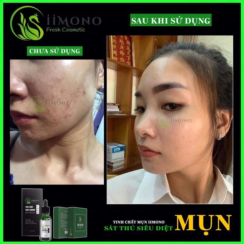 Tinh chất mụn IIMONO 20ml serum | BigBuy360 - bigbuy360.vn