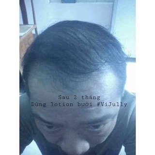TINH DẦU BƯỞI TRỊ RỤNG TÓC VIJULLY