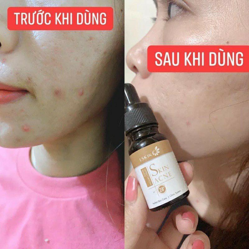 [RẺ VÔ ĐỊCH] Cốt Mụn Bạch Sen Lskin Đan Thy | BigBuy360 - bigbuy360.vn